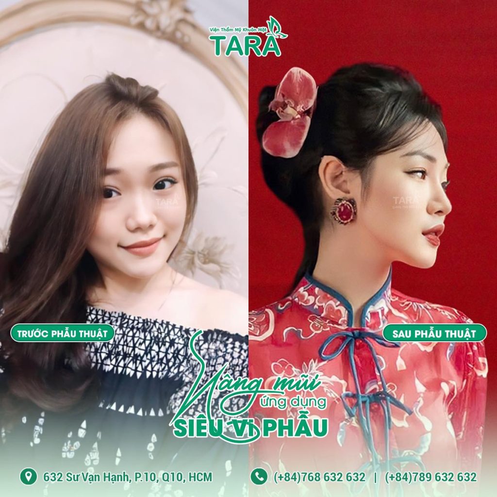 7 kinh nghiệm chọn địa chỉ nâng mũi đẹp tại Sài Gòn: Dr Trang TARA địa chỉ đáng cân nhắc