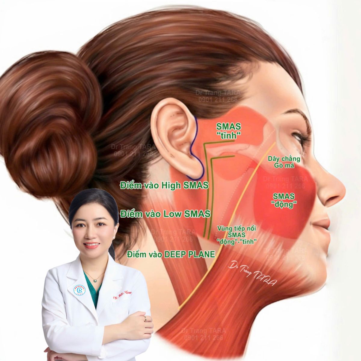 Giải phẫu Căng da mặt Deep Plane và Căng da mặt SMAS