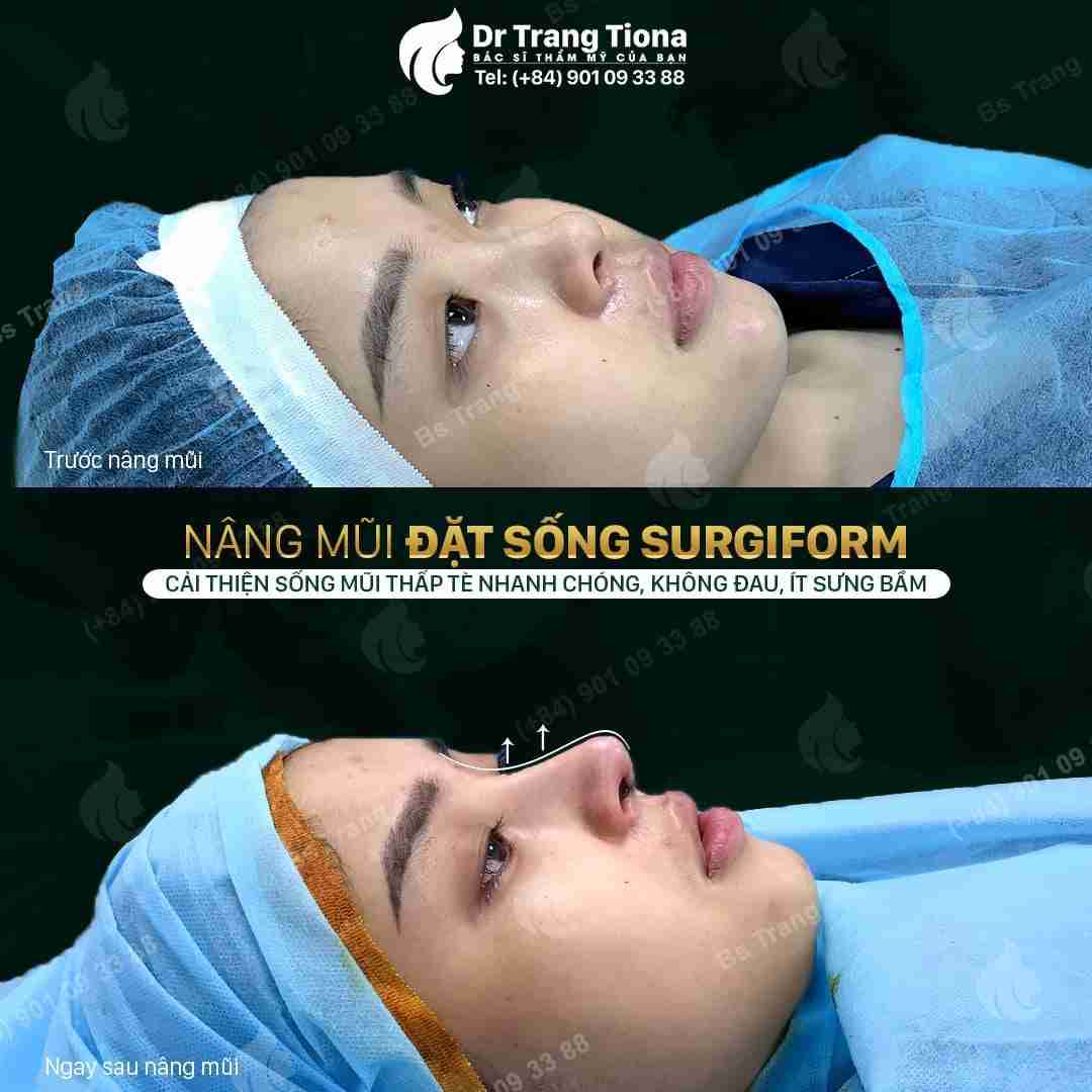Bác sĩ giải đáp: Nâng mũi bị đỏ đầu mũi có sao không?