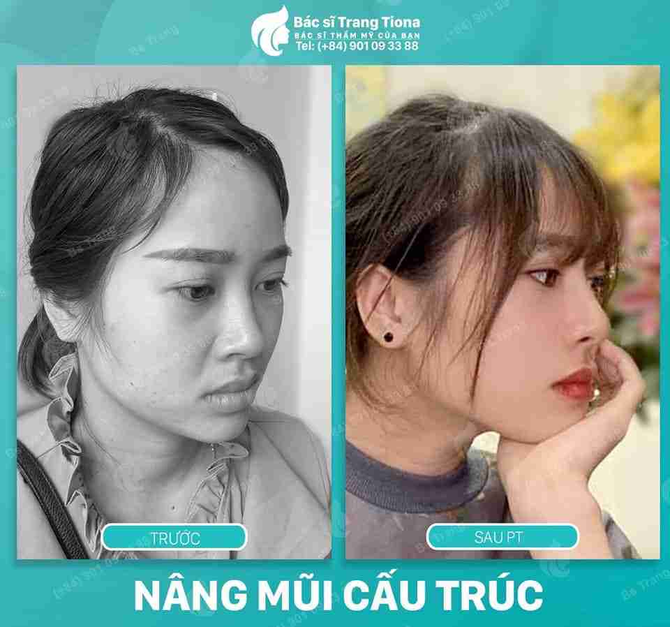 Bác sĩ giải đáp: Nâng mũi xong ăn nấm được không?