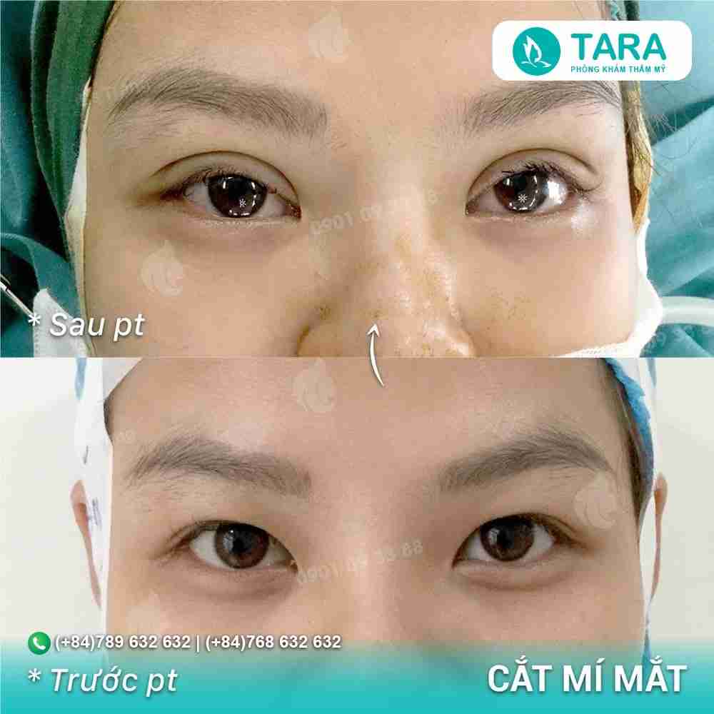 Bác sĩ nói gì: 5 lưu ý khi thực hiện cắt mí mắt?