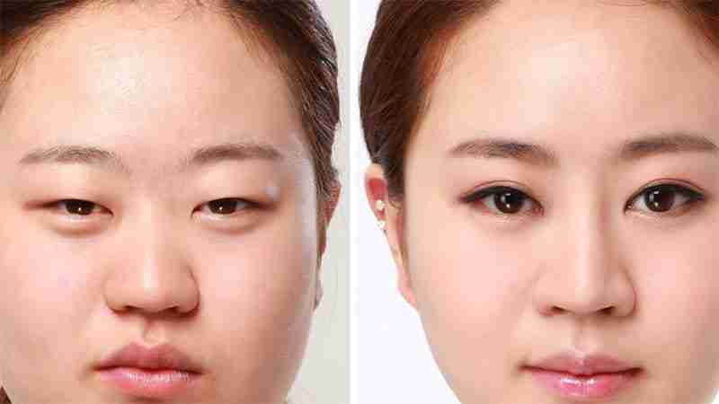 Bác sĩ Trang giải đáp: Cắt mí kiêng ăn gì