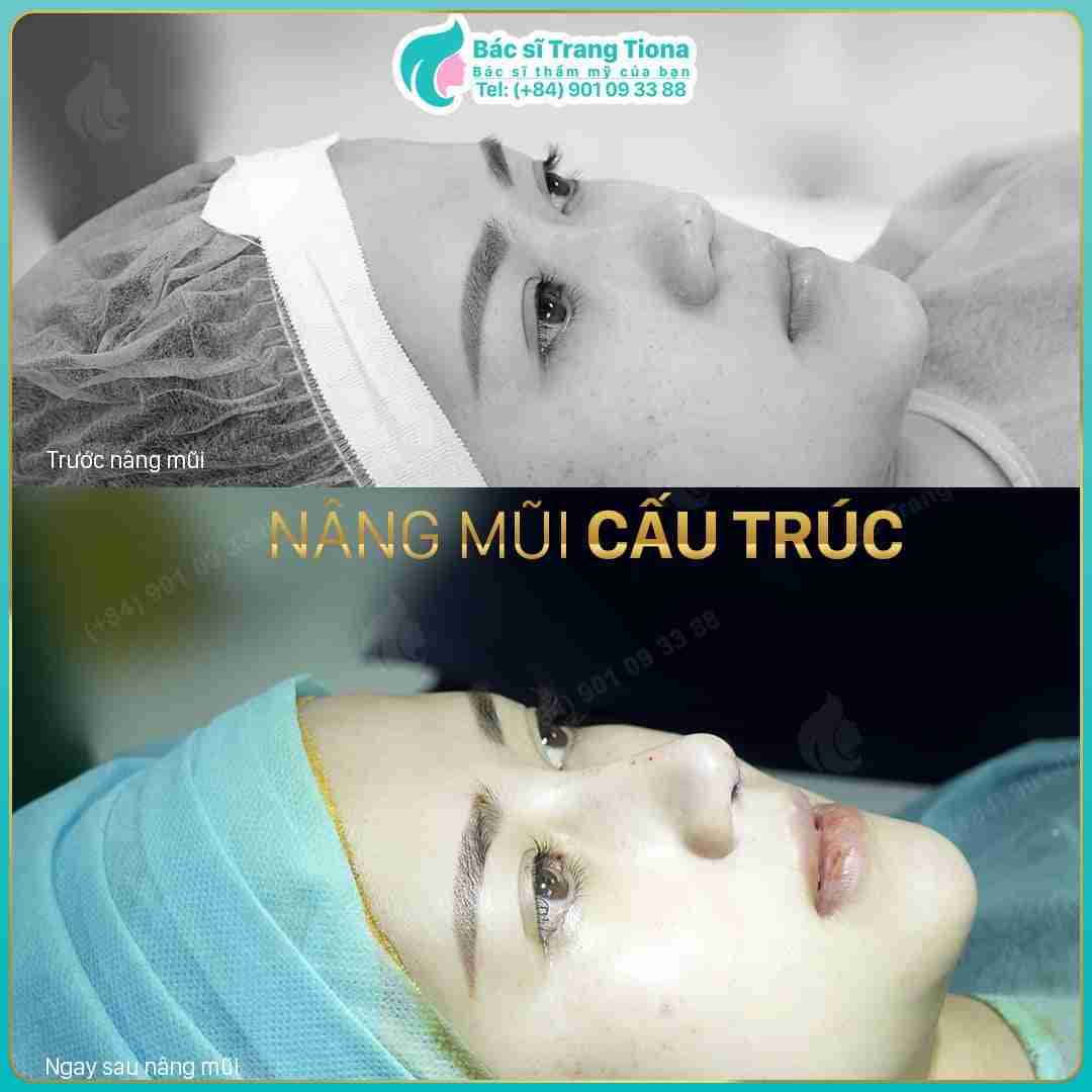 Bật mí 7 bí quyết để nâng mũi cấu trúc Surgiform đẹp