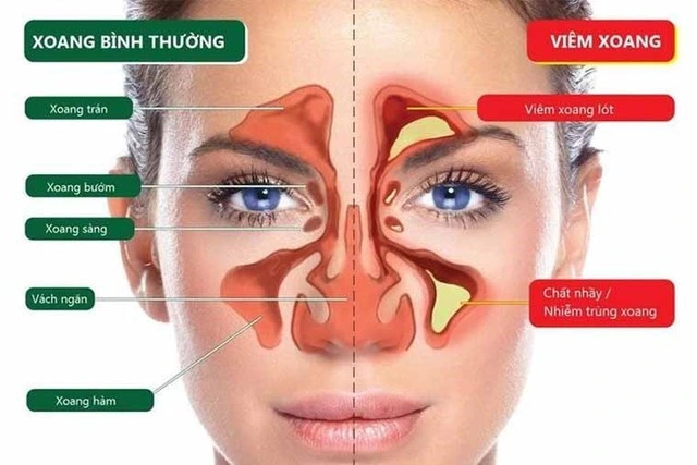 Bị viêm xoang mũi dị ứng nâng mũi có sao không?