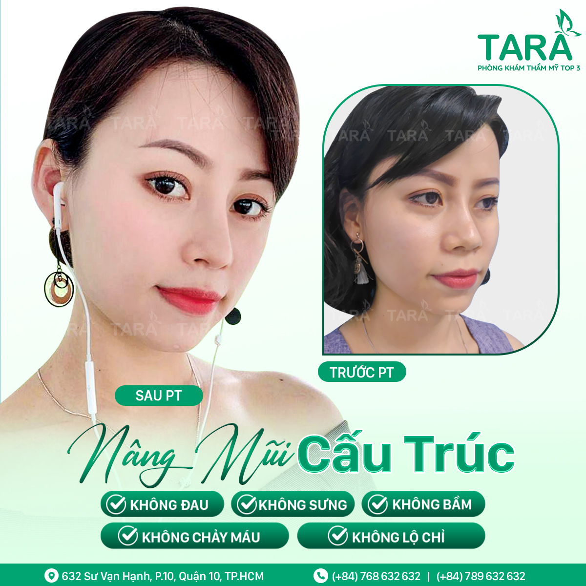 Bị viêm xoang mũi dị ứng nâng mũi có sao không?