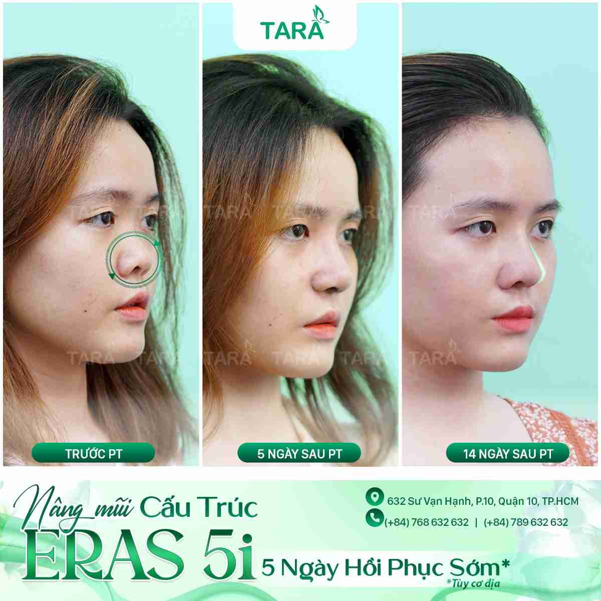 Cách hay nhất để xử lý đầu mũi bị hếch