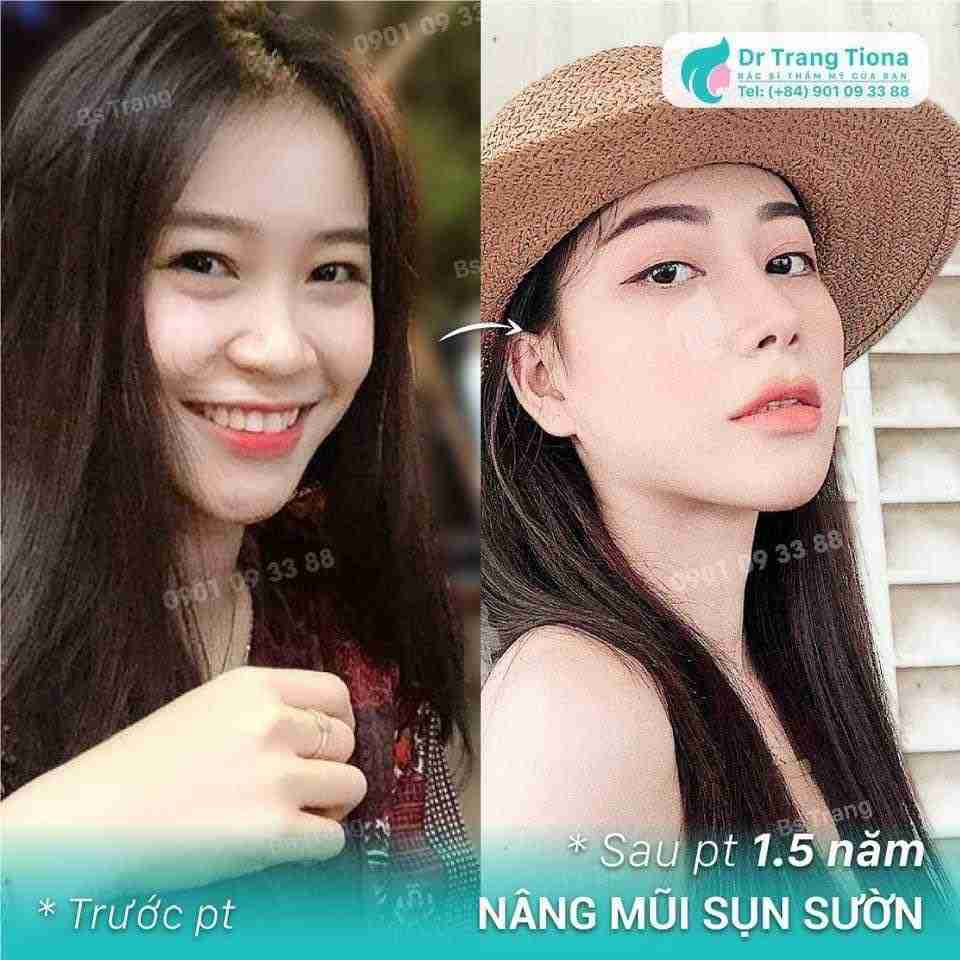 Cảm giác sau khi nâng mũi như nào? Khó chịu không?