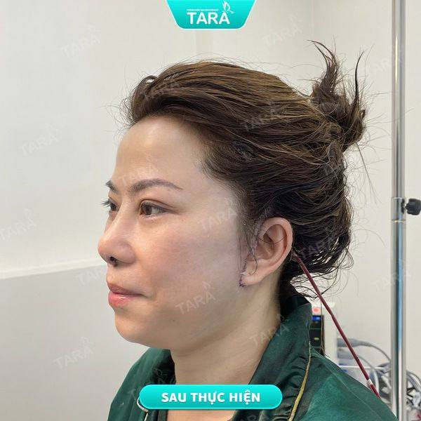 Căng da mặt nội soi là gì? Thực hiện như thế nào?