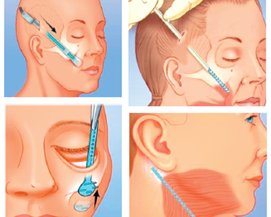 Căng da Midface có phù hợp với nam giới không?