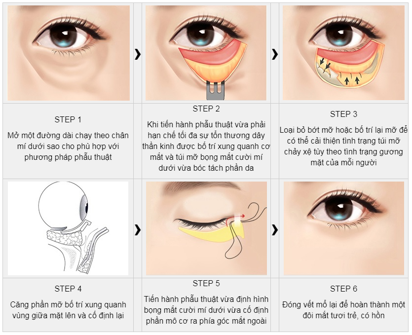 Căng da Midface có thể đi làm lại ngay không?