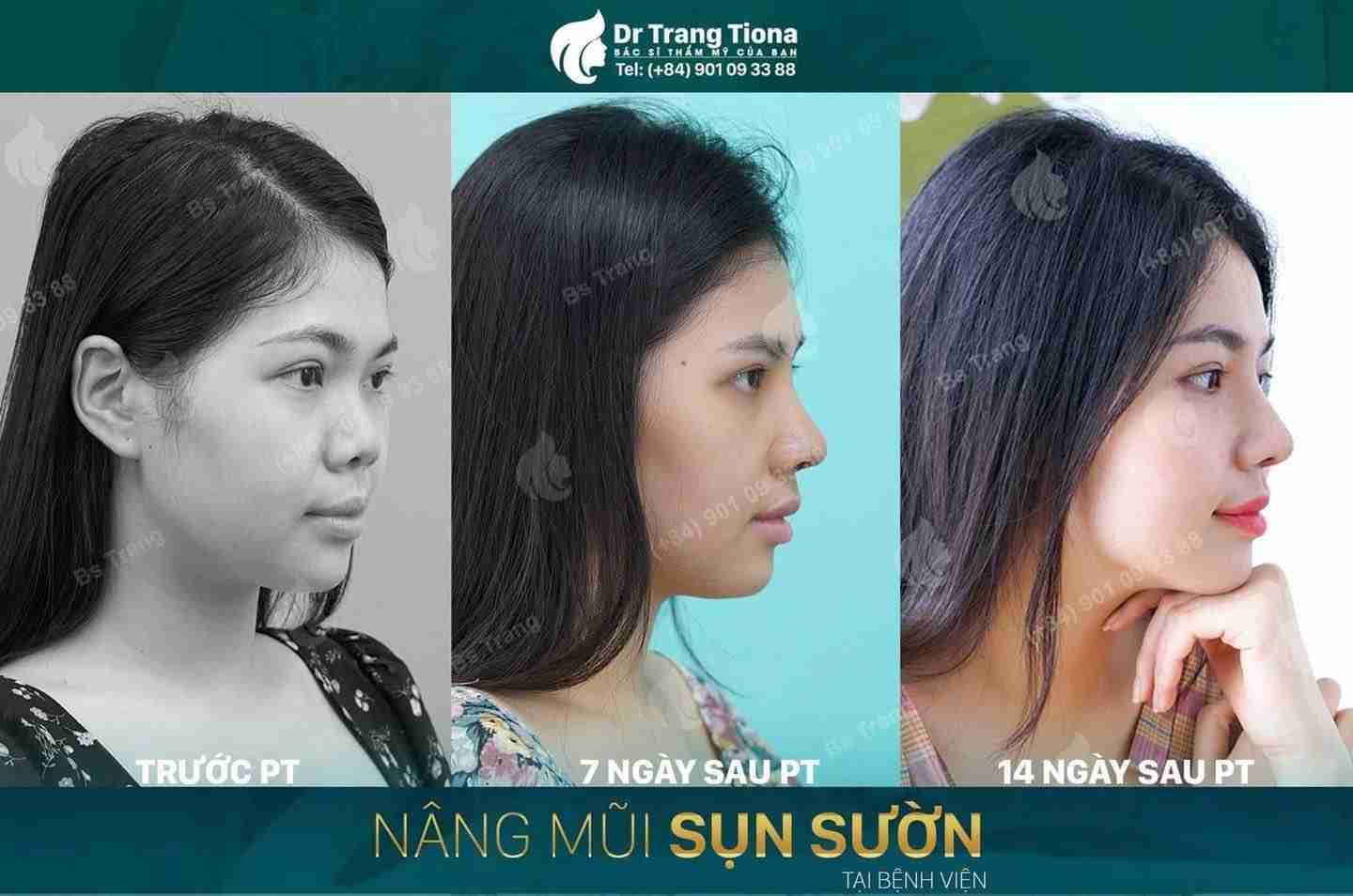 Cắt chỉ sau nâng mũi có đau không? Có nên tự cắt chỉ?