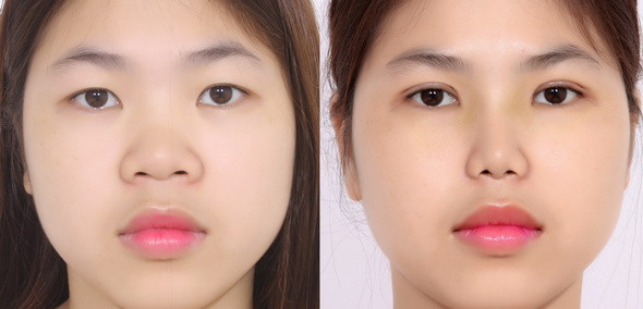 Cắt mí hay nhấn mí? Đâu là lựa chọn tối ưu?
