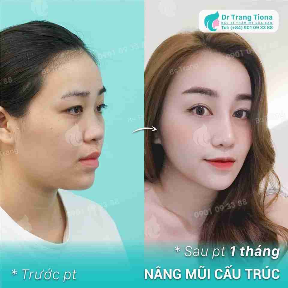 Có nên nâng mũi bây giờ để kịp đón Tết?
