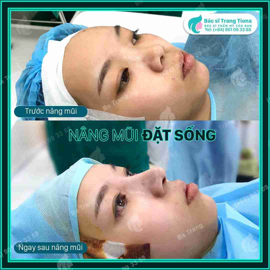 Có nên vận động nhiều sau nâng mũi? Tại sao?