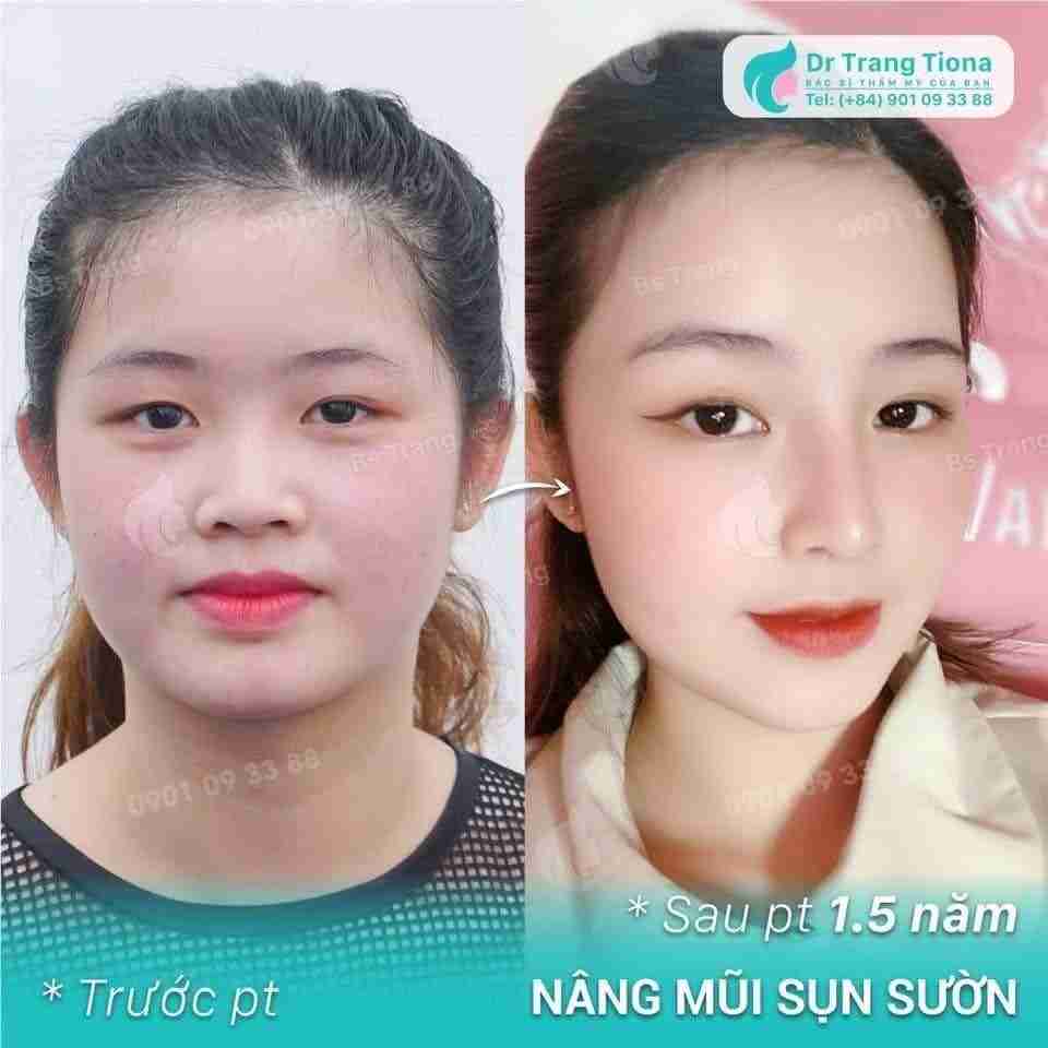 Đâu là dáng mũi phù hợp cho người mặt tròn?