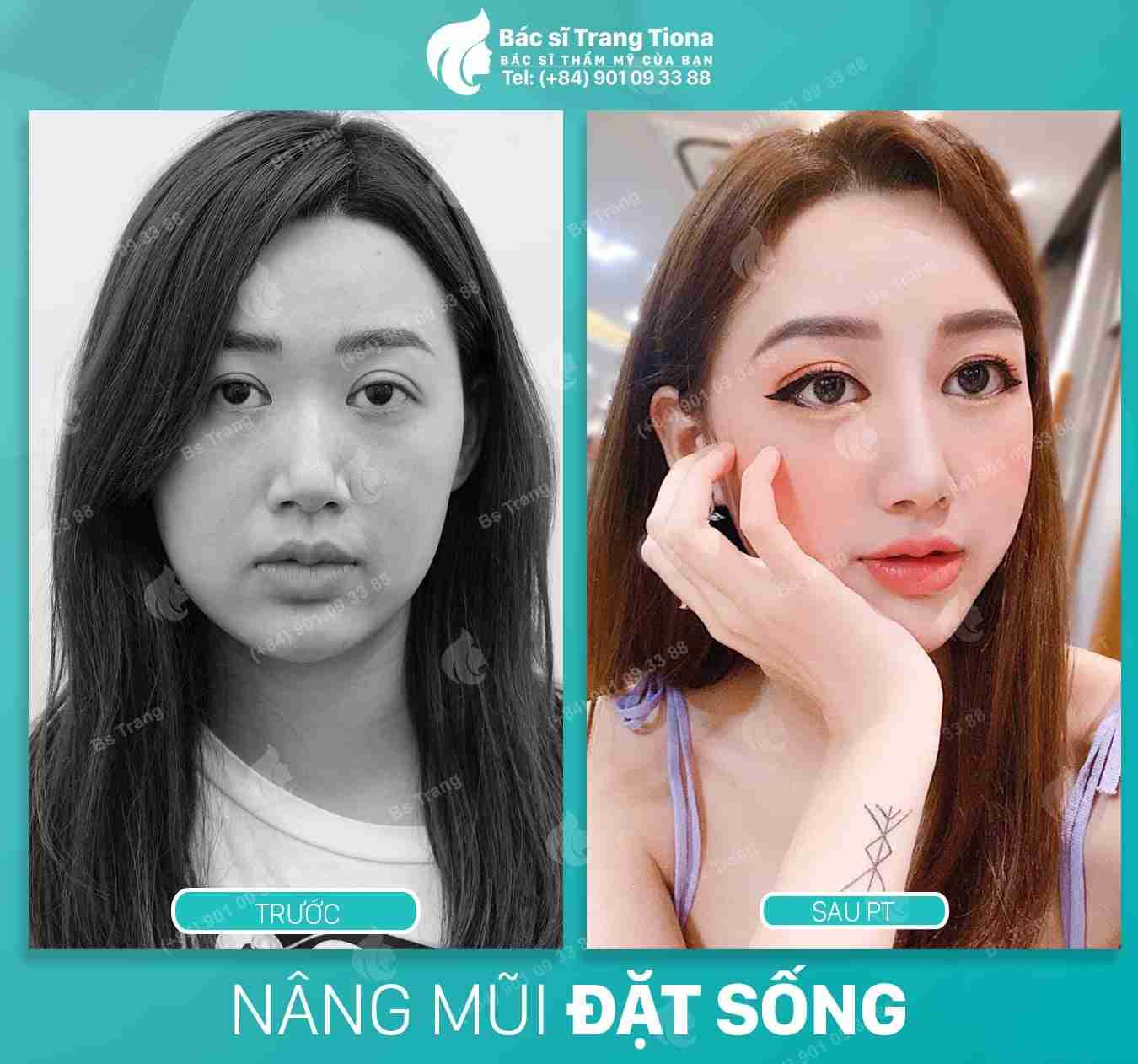 Đâu là phương pháp nâng mũi hiện đại nhất hiện nay?