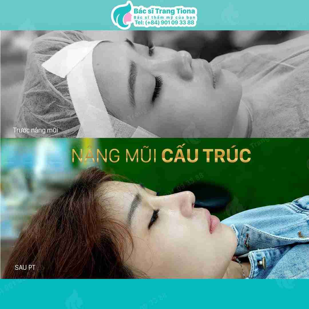 Đâu là phương pháp nâng mũi hiện đại nhất hiện nay?