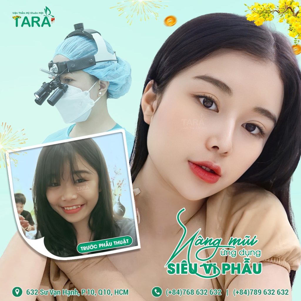 Địa chỉ nâng mũi không nẹp cứng uy tín tại Quận 10