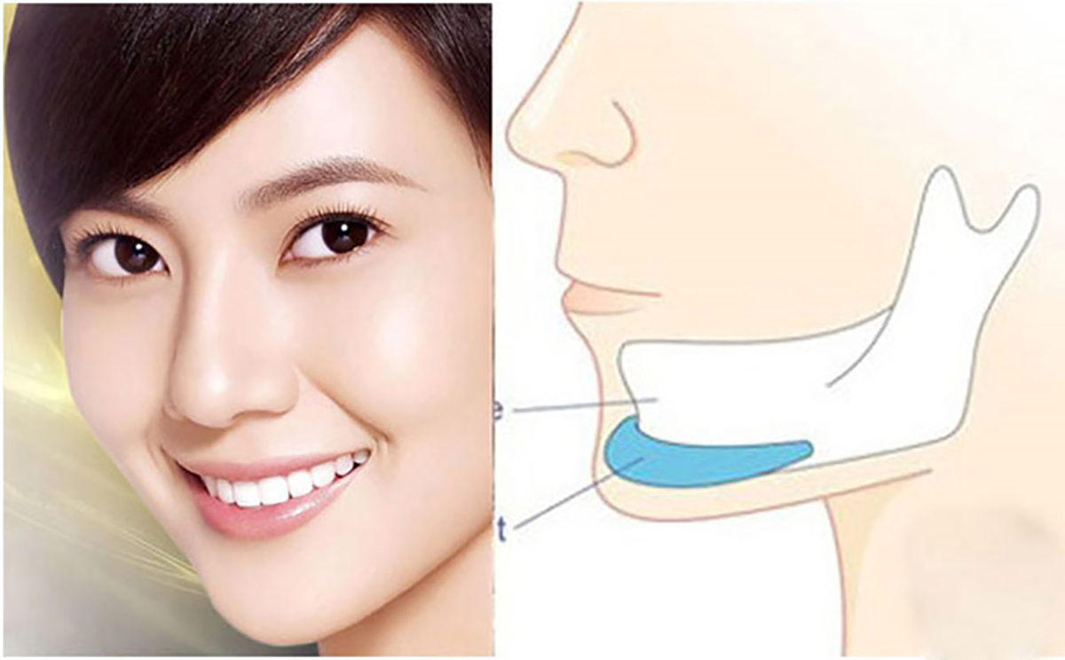 Độn cằm có gây nguy hiểm không?