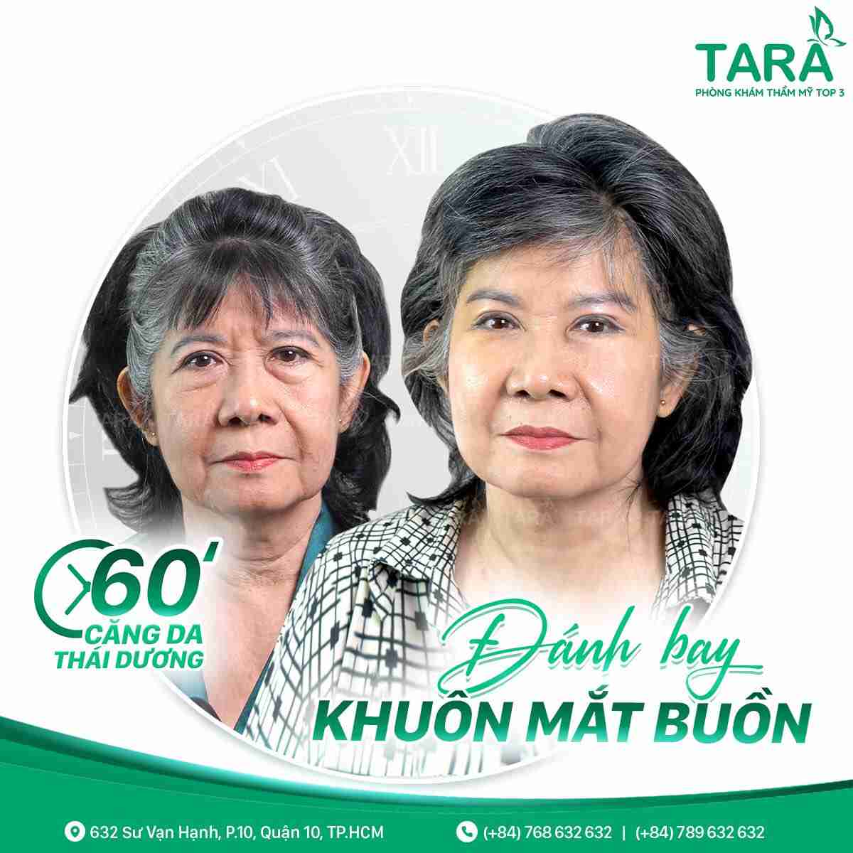 Giải đáp tất tần tật về căng da mặt bán phần
