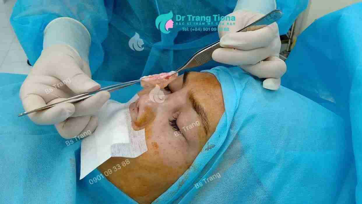 Giải đáp: Nâng mũi trung bì mỡ có đau không?