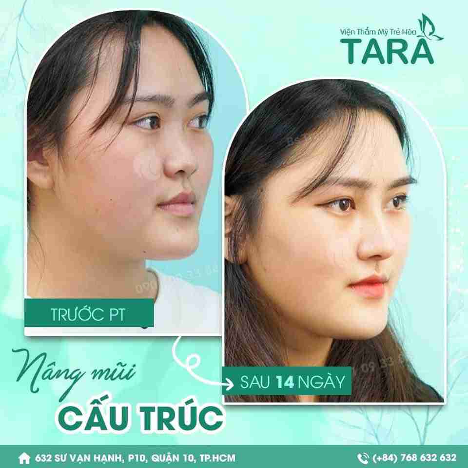 Hình ảnh nâng mũi cấu trúc sau 14 ngày trông như thế nào?