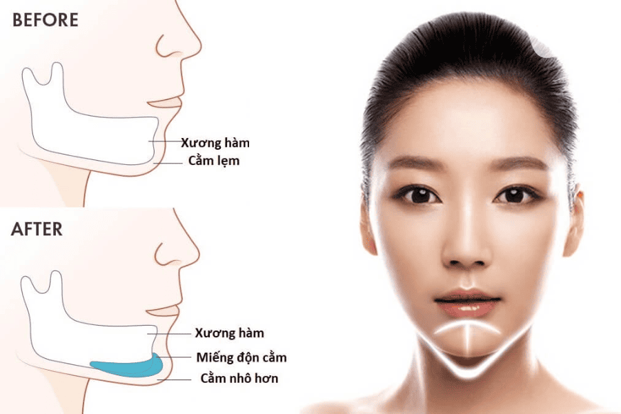 Hướng dẫn vệ sinh sau khi độn cằm sụn Surgiform