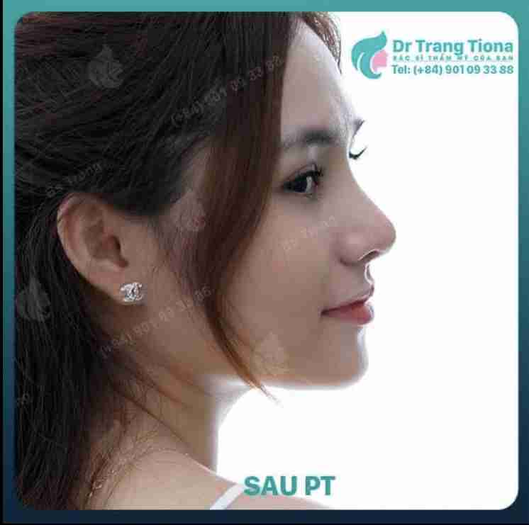 Đi tìm cách khắc phục sống mũi gãy hiệu quả