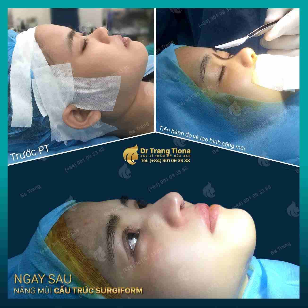 Đi tìm cách khắc phục sống mũi gãy hiệu quả