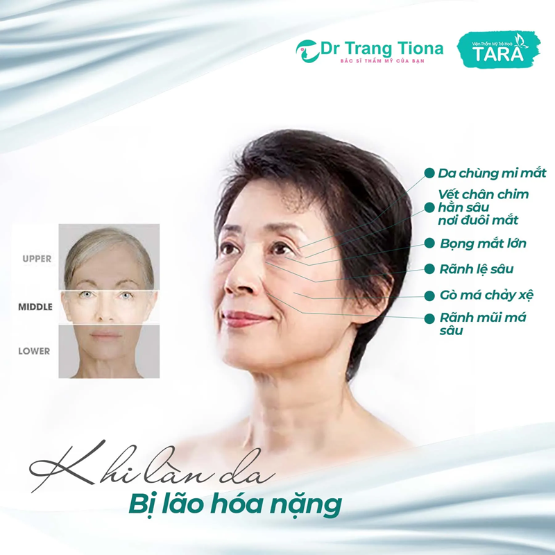 Khi nào nên phẫu thuật căng da mi dưới Midface