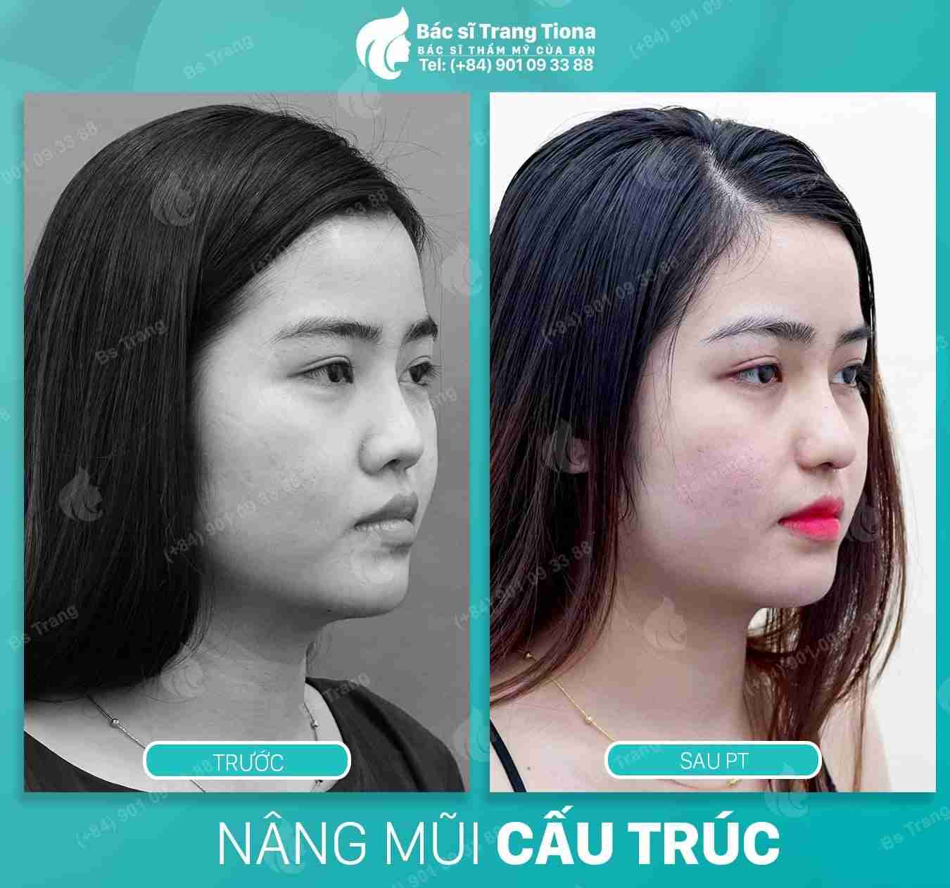 Tất tần tật về kinh nghiệm nâng mũi Sline dành cho người mới