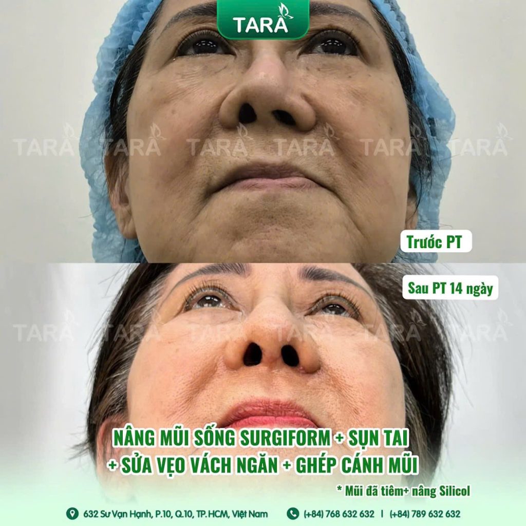 Lệch vẹo, co rút, nhiễm trùng: Dấu hiệu nguy hiểm sau nâng mũi