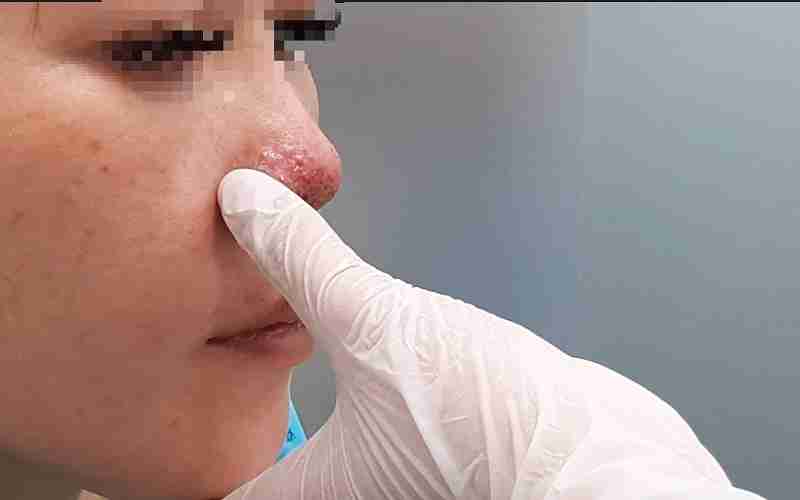 Lộ sụn đầu mũi và dấu hiệu nhận biết để kịp chữa trị