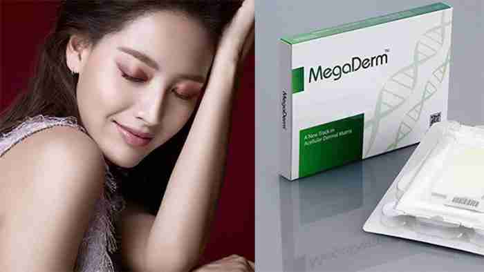 Điểm danh 4 lợi ích nâng mũi bọc sụn Megaderm