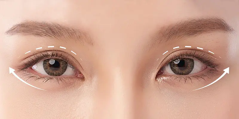 Mắt bị trợn sau khi cắt mí thì phải làm sao?