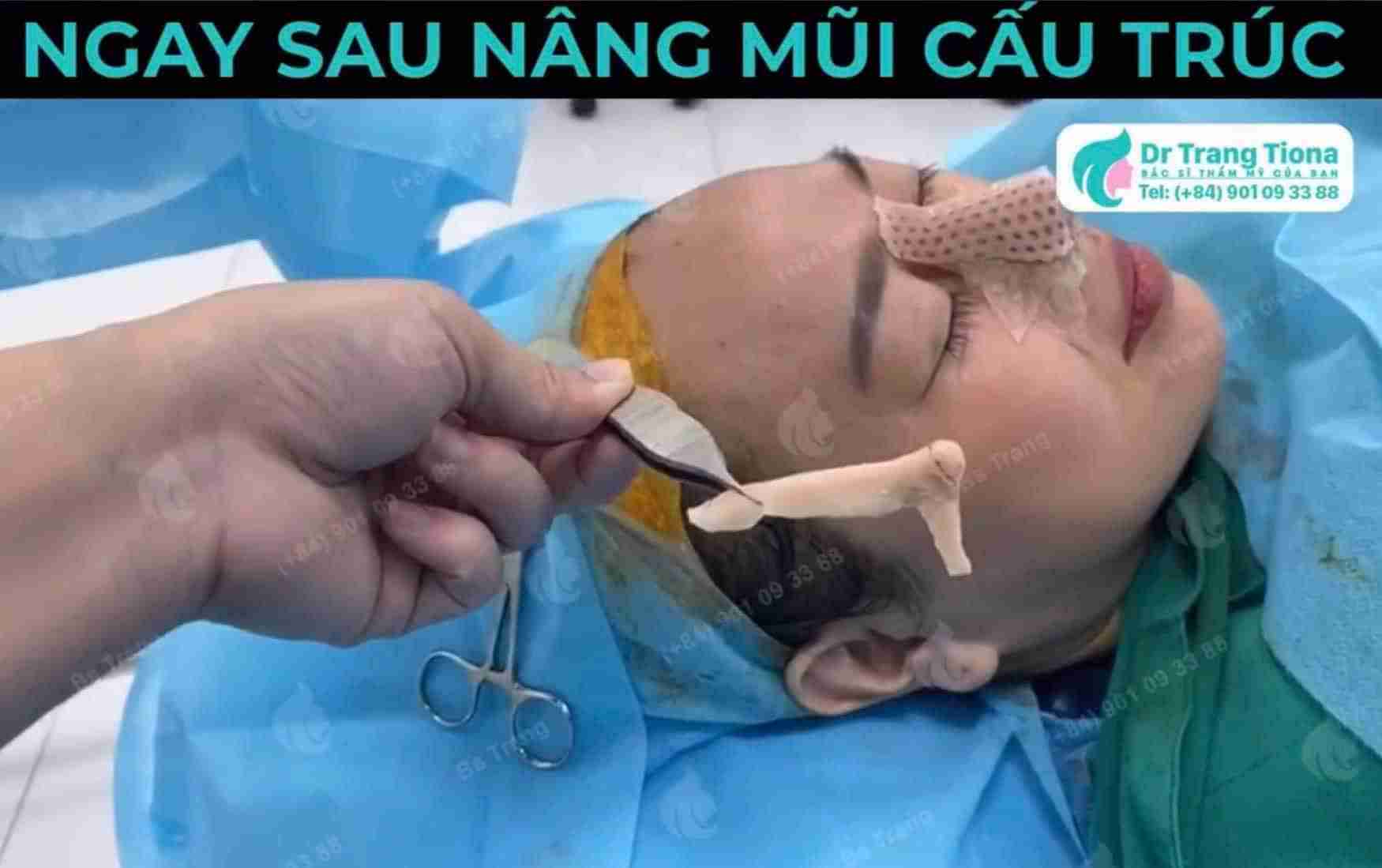 Mũi bị sưng to sau khi tháo nẹp có nguy hiểm không?