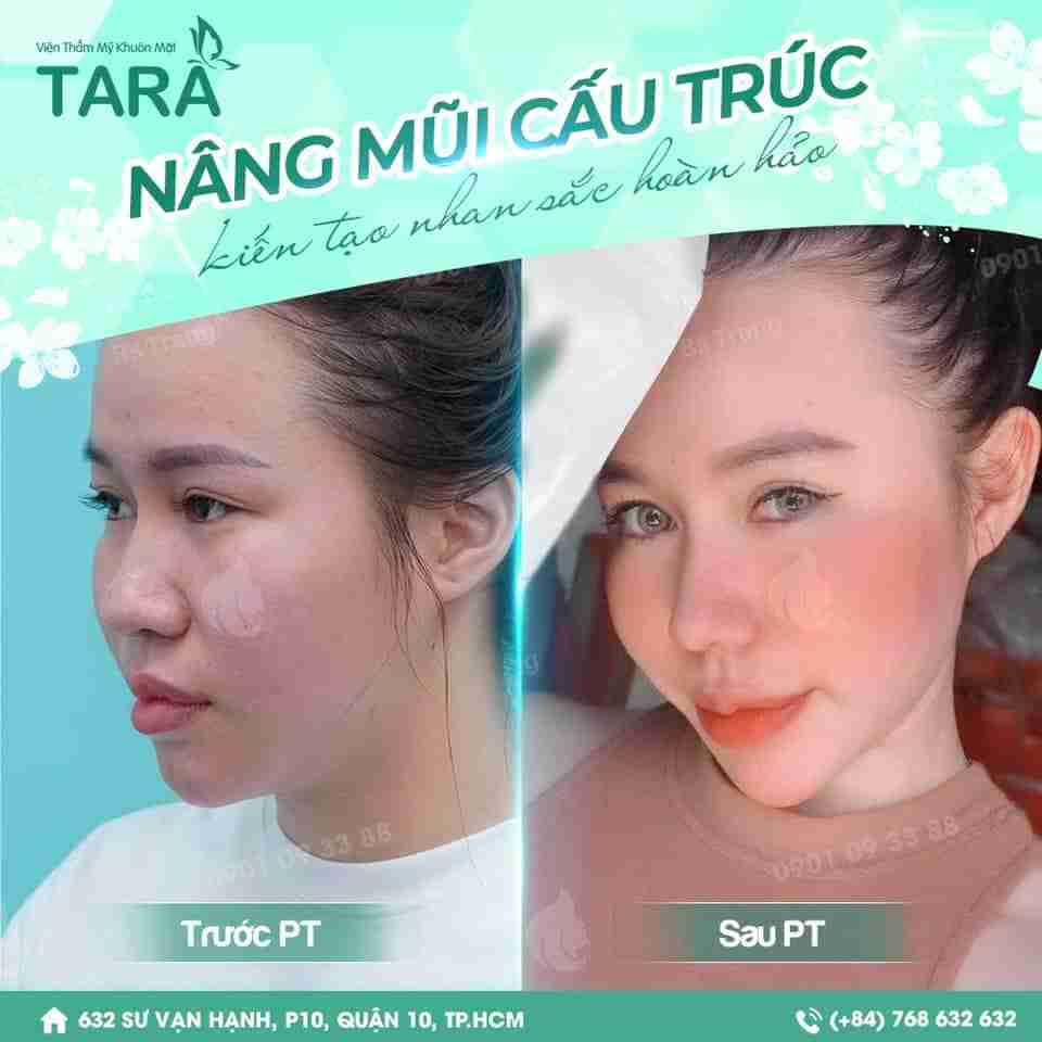 Mũi bị sưng to sau khi tháo nẹp có nguy hiểm không?