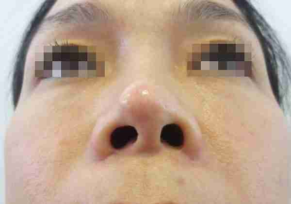 Mũi bị tụt sụn thì phải làm sao? Nguyên nhân và cách điều trị