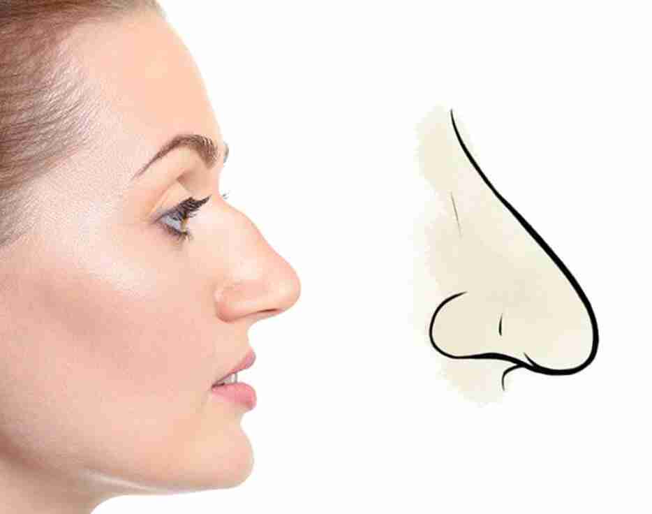Mũi diều hâu hay mũi két là gì? Có nên sửa hay không?