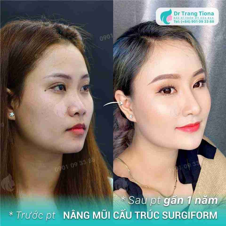 Mũi tẹt ảnh hưởng thế nào đến đời sống và tình cảm?