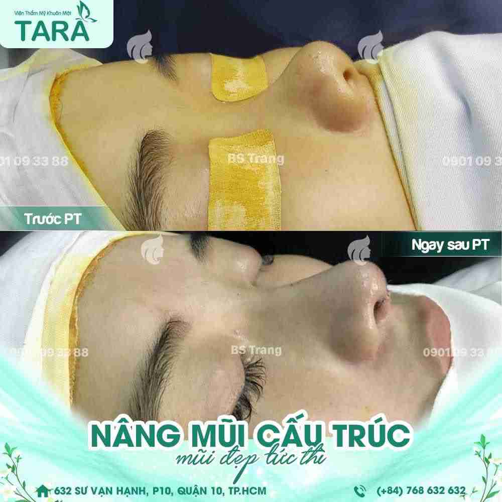 Nâng mũi ăn trứng có nguy hiểm không? Tại sao?