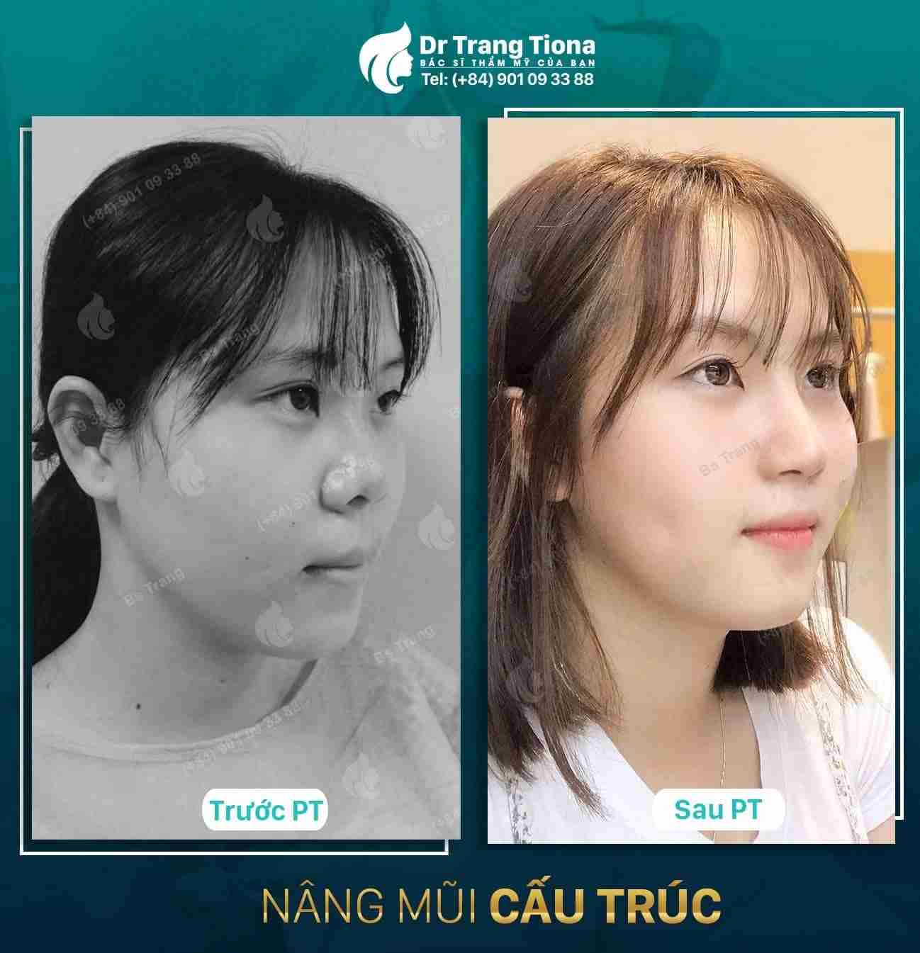 Bác sĩ giải đáp: Nâng mũi bằng sụn tai có bị teo không?