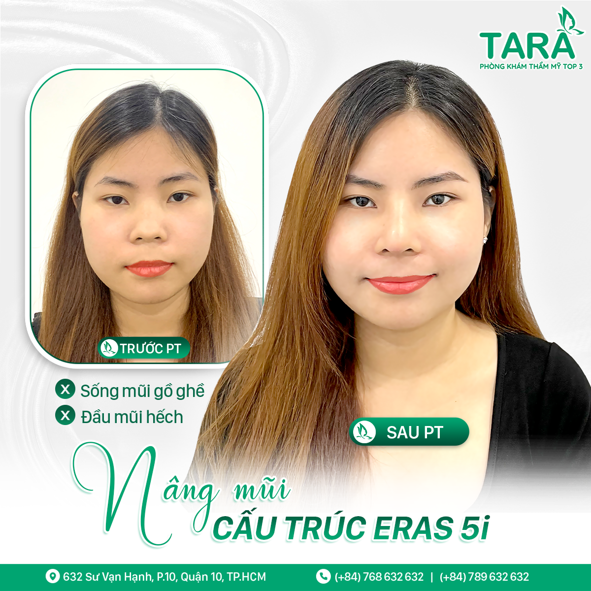 Nâng mũi sụn tự thân là gì? Có nên nâng mũi bằng sụn tự thân không?