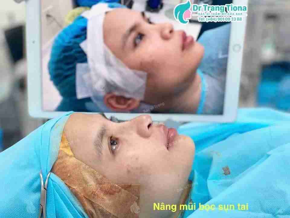 Nâng mũi bằng sụn tự thân nên chọn loại sụn nào thì tốt nhất?