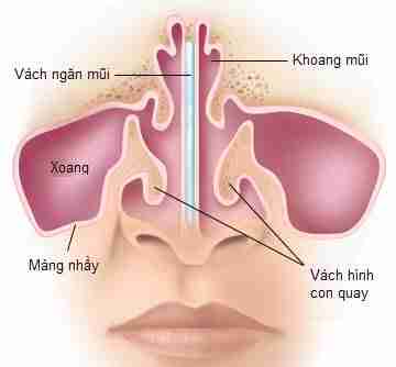 Nâng mũi bằng sụn tự thân nên chọn loại sụn nào thì tốt nhất?