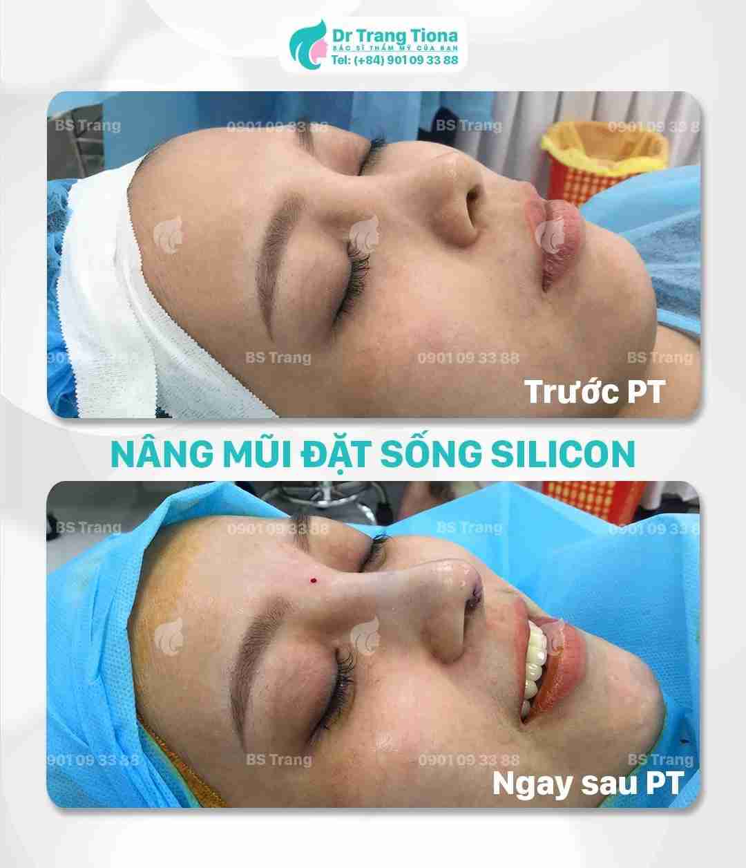 Bác sĩ giải đáp: Nâng mũi bao lâu thì được vặn vẹo mũi?