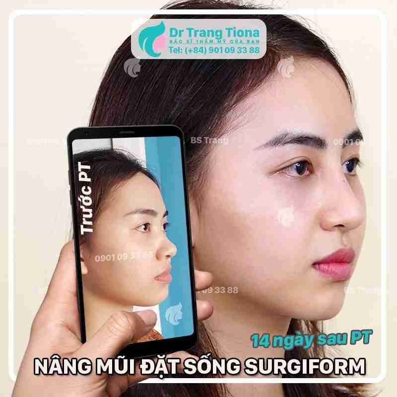 Bác sĩ giải đáp: Nâng mũi bao lâu thì được vặn vẹo mũi?