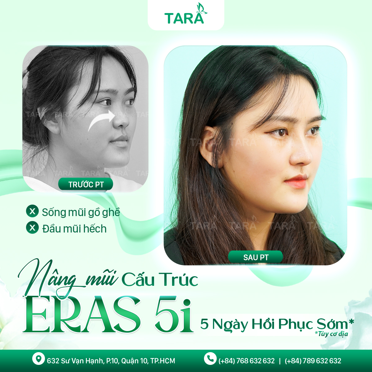 Nâng mũi cấu trúc bao lâu thì được make up?