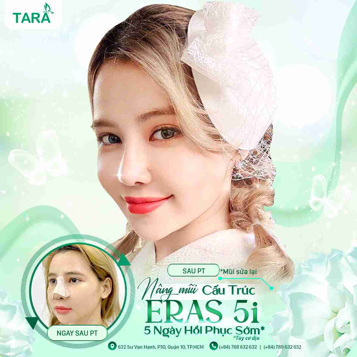 Nâng mũi cấu trúc bao thì ổn định?