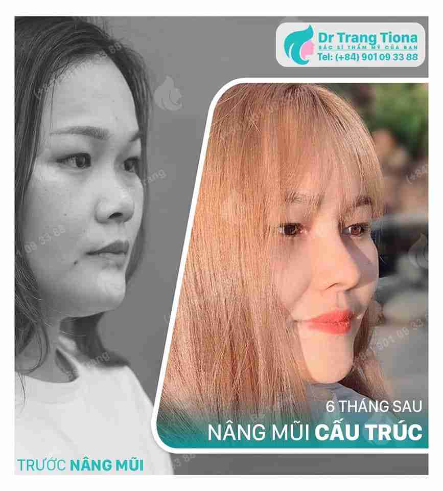 Nâng mũi cấu trúc duy trì hiệu quả bao lâu? 20 năm? 30 năm?
